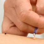 鍼灸